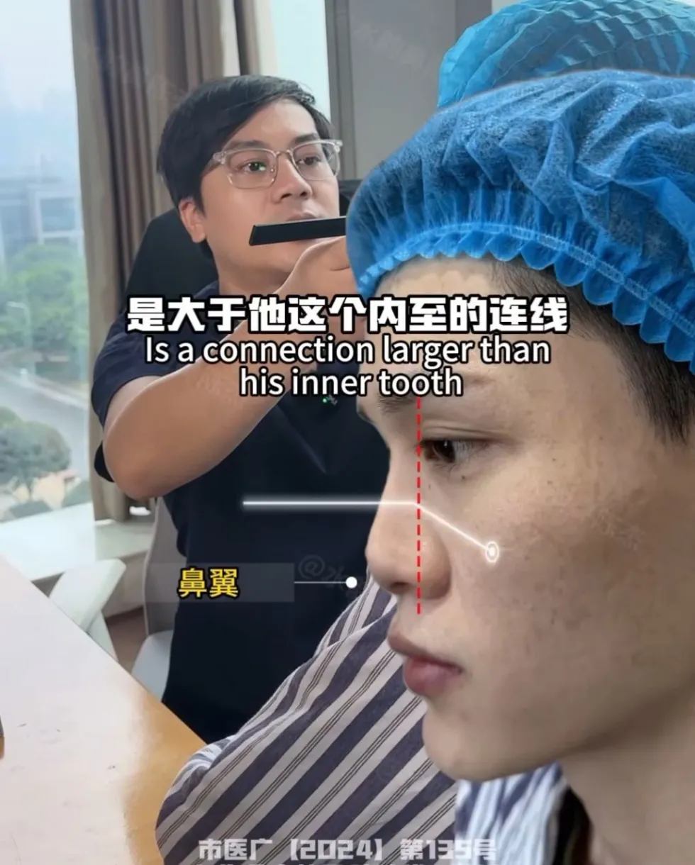 남자 코 수술의 전설적인 사례