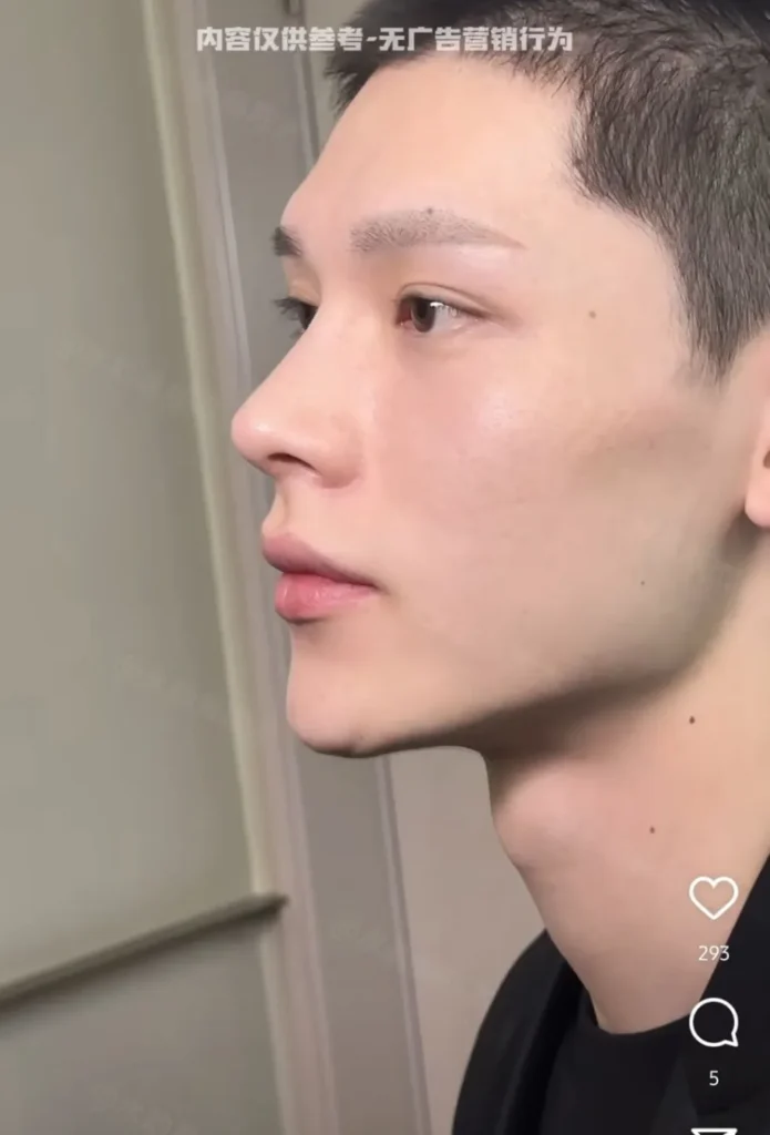 남자 코 수술의 전설적인 사례