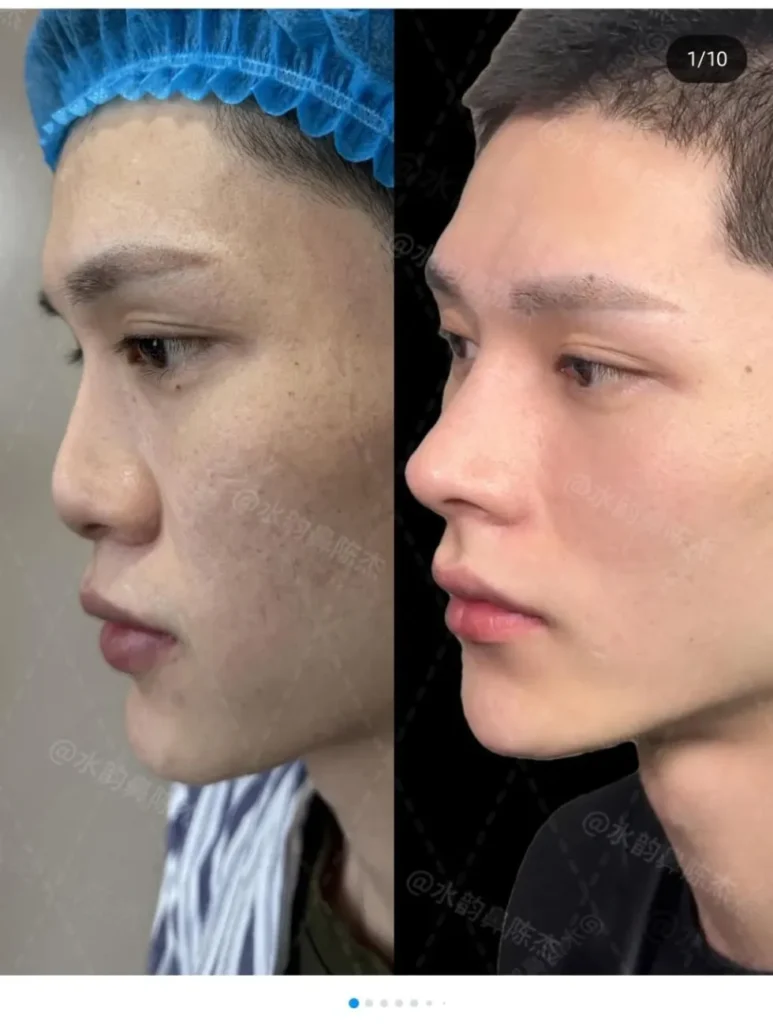 남자 코 수술의 전설적인 사례