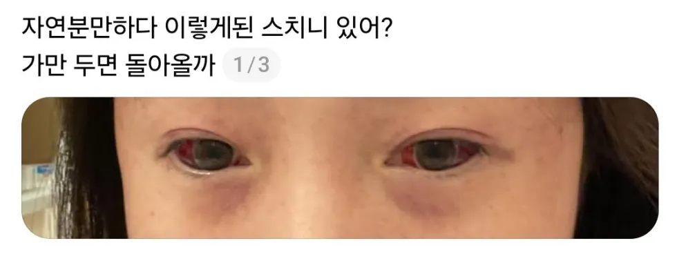 자연분만 후 산모들의 상태 (사진 주의).