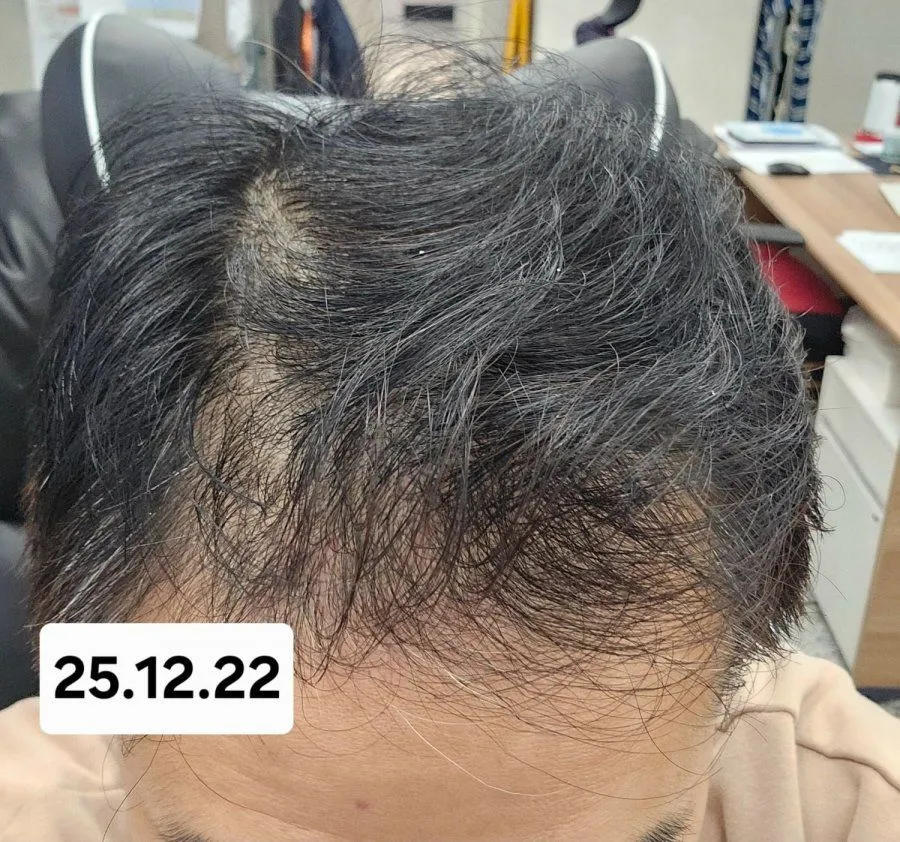 6개월간 탈모약 복용 후 놀라운 변화