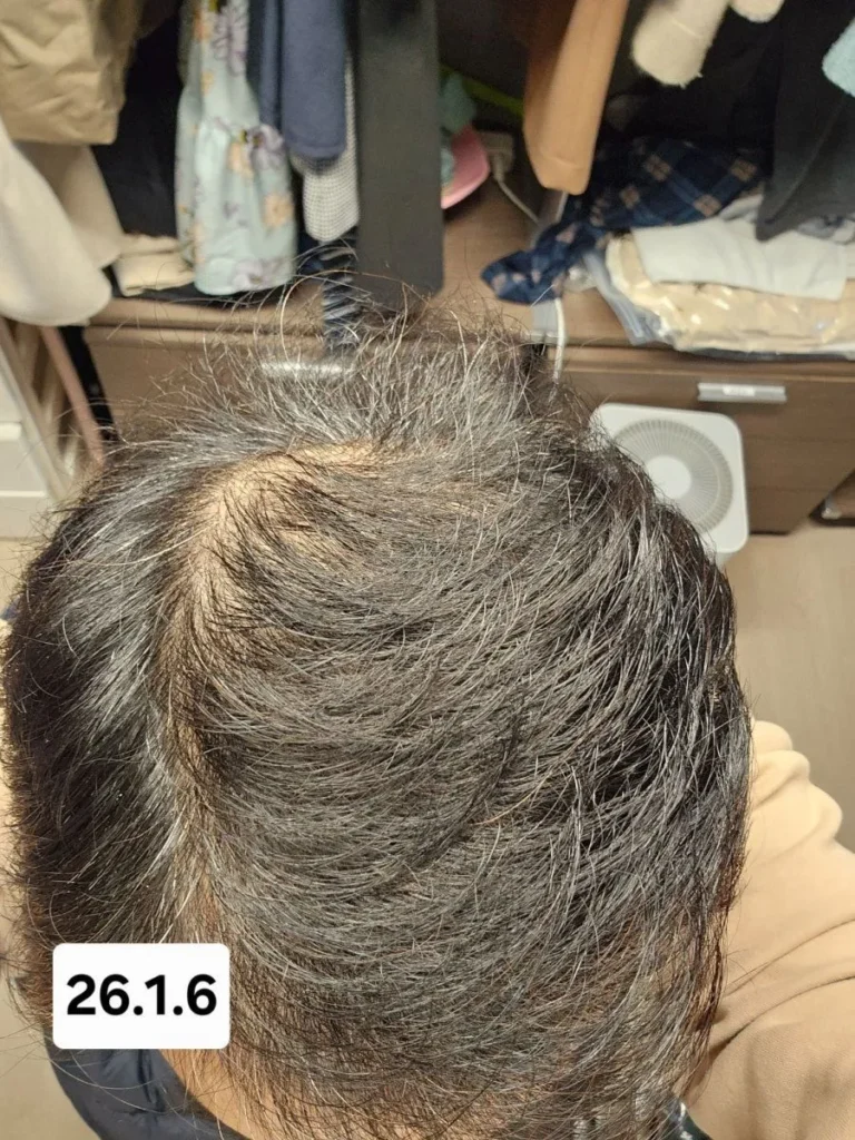 6개월간 탈모약 복용 후 놀라운 변화
