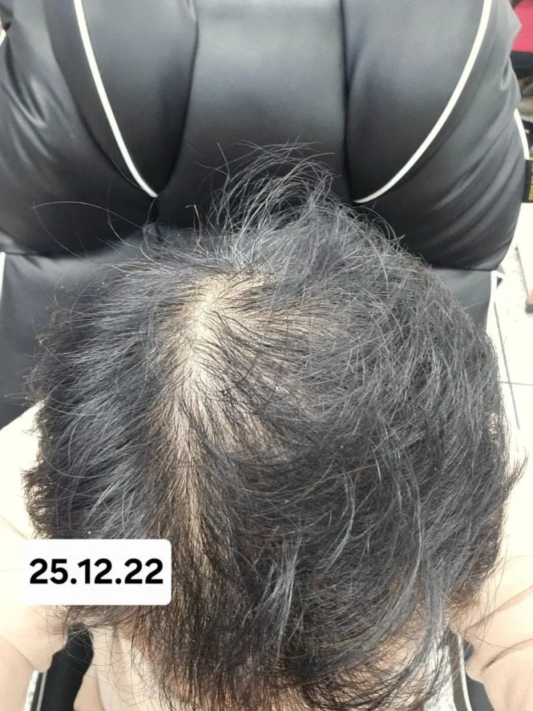 6개월간 탈모약 복용 후 놀라운 변화