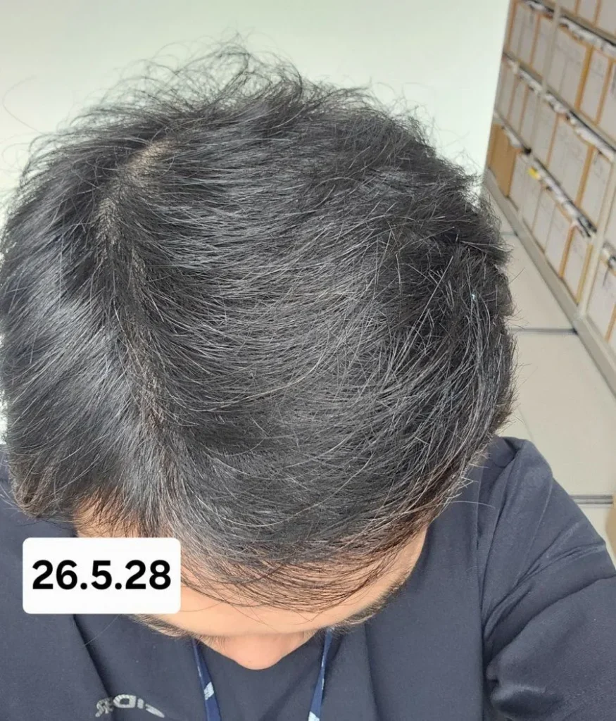 6개월간 탈모약 복용 후 놀라운 변화