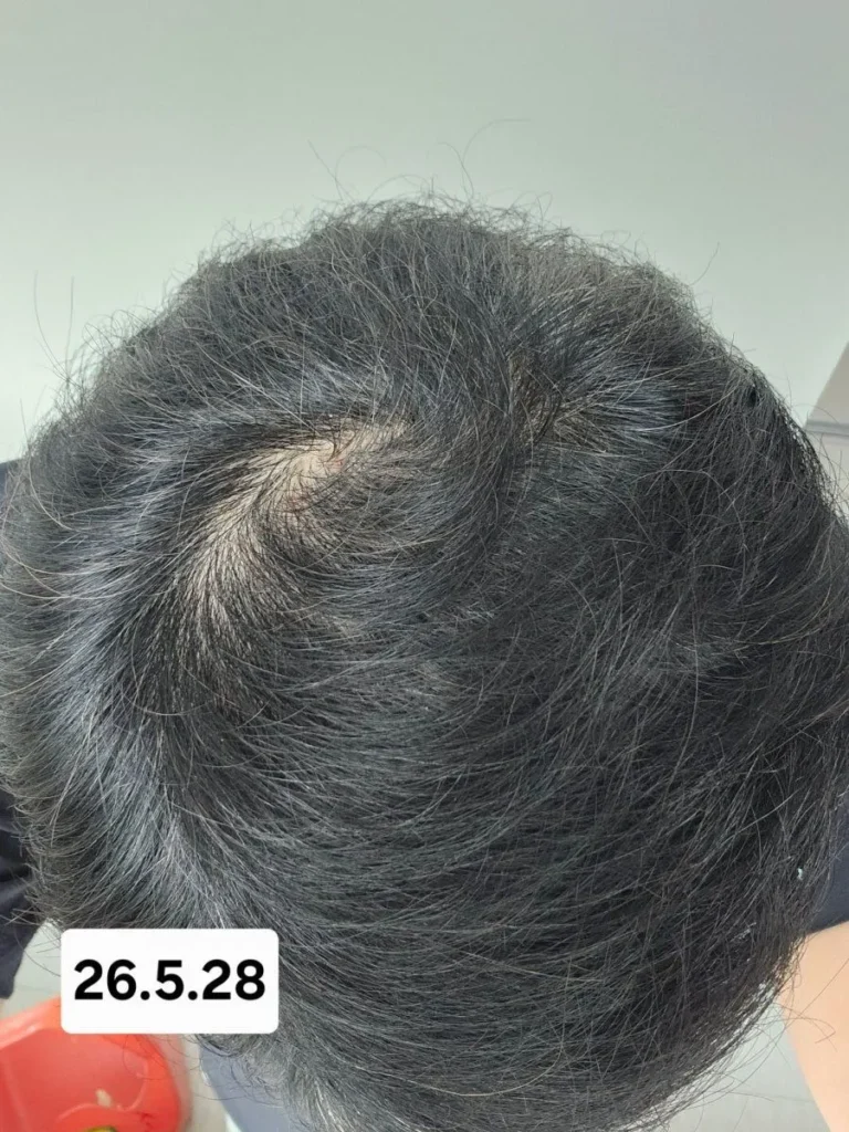 6개월간 탈모약 복용 후 놀라운 변화