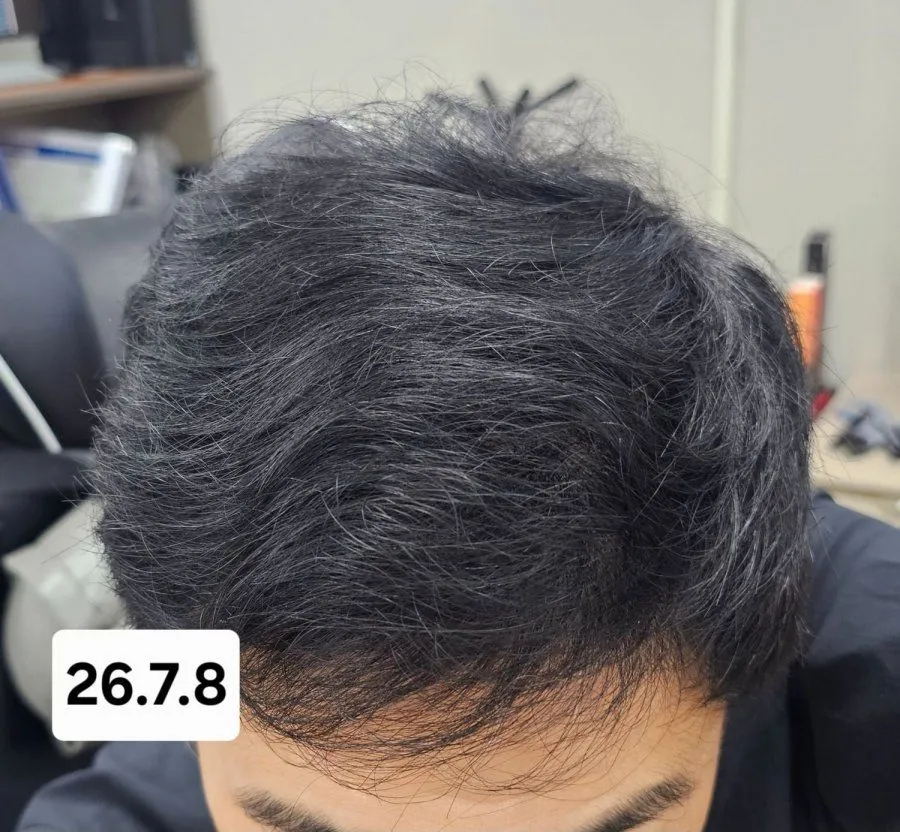 6개월간 탈모약 복용 후 놀라운 변화