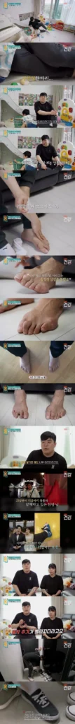 30대 남성 통풍 환자의 발 상태에 대한 내용.