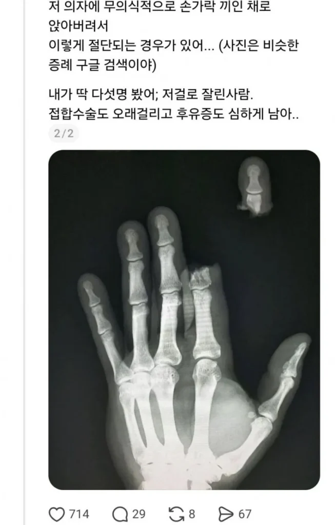 고깃집에서 손가락 절단 사고 주의
