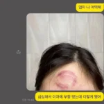 한심하게 생각했던 어머니, 머리에 부황 뜬 딸
