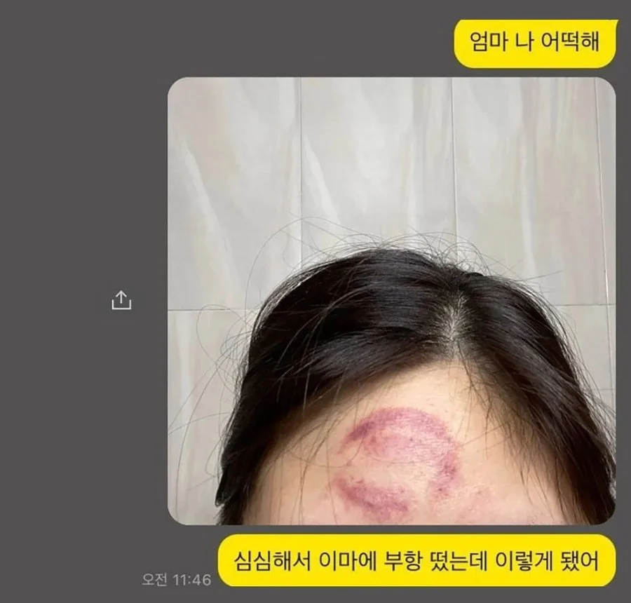 한심하게 생각했던 어머니, 머리에 부황 뜬 딸