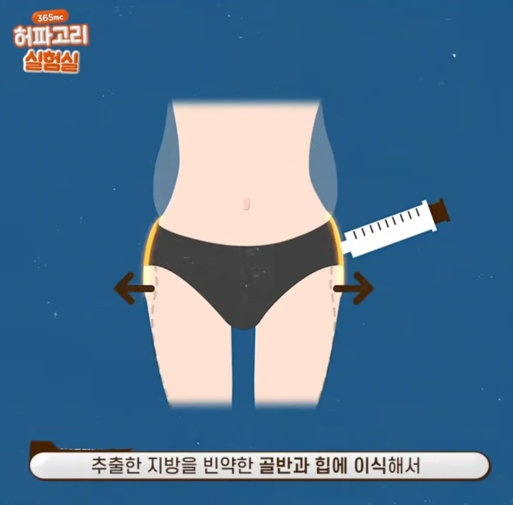 요즘 여성들에게 인기 있는 몸매 교정 시술