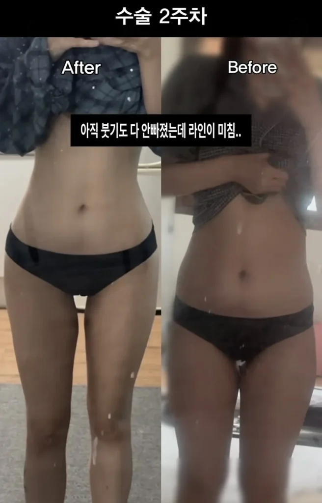요즘 여성들에게 인기 있는 몸매 교정 시술