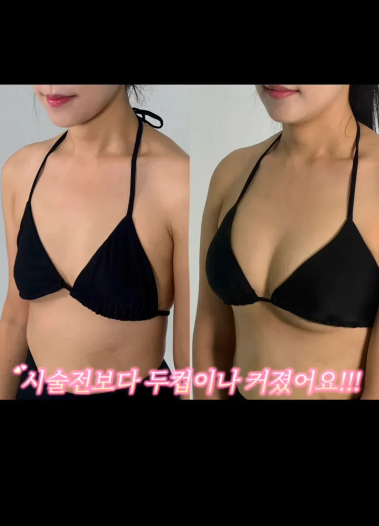 요즘 여성들에게 인기 있는 몸매 교정 시술
