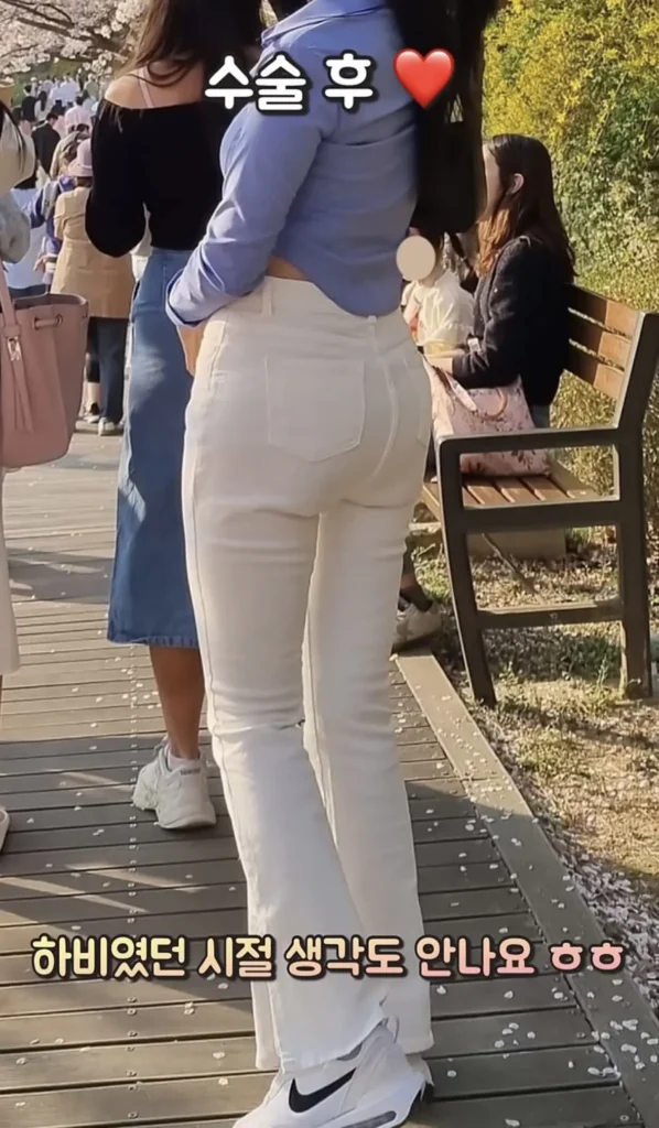 요즘 여성들에게 인기 있는 몸매 교정 시술