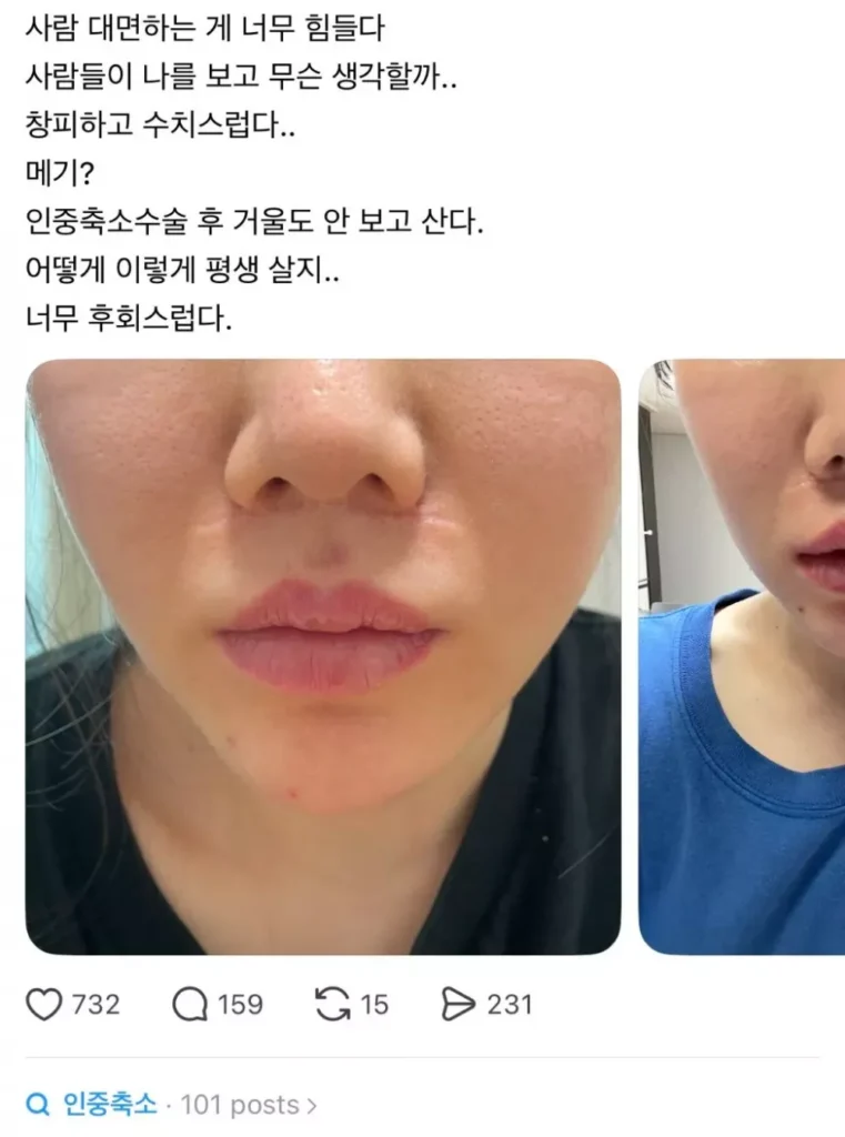 (약혐) 쓰레드에서 핫한 인중축소 성형수술 피해자들