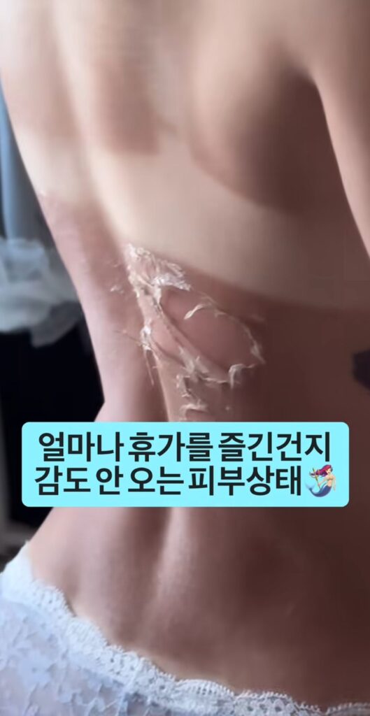 휴가 후 여자의 피부 상태 변화