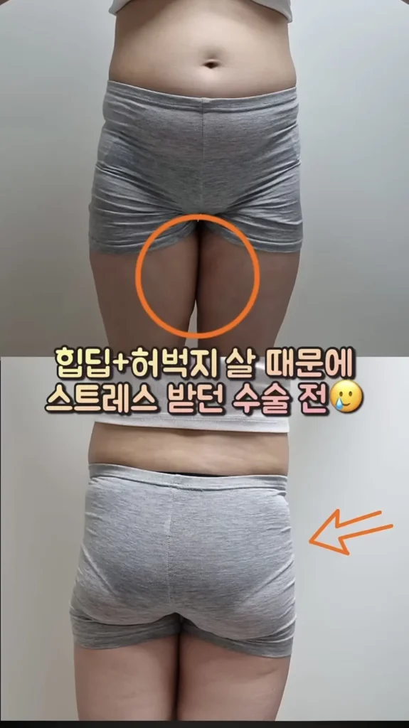 요즘 여성들에게 인기 있는 몸매 교정 시술