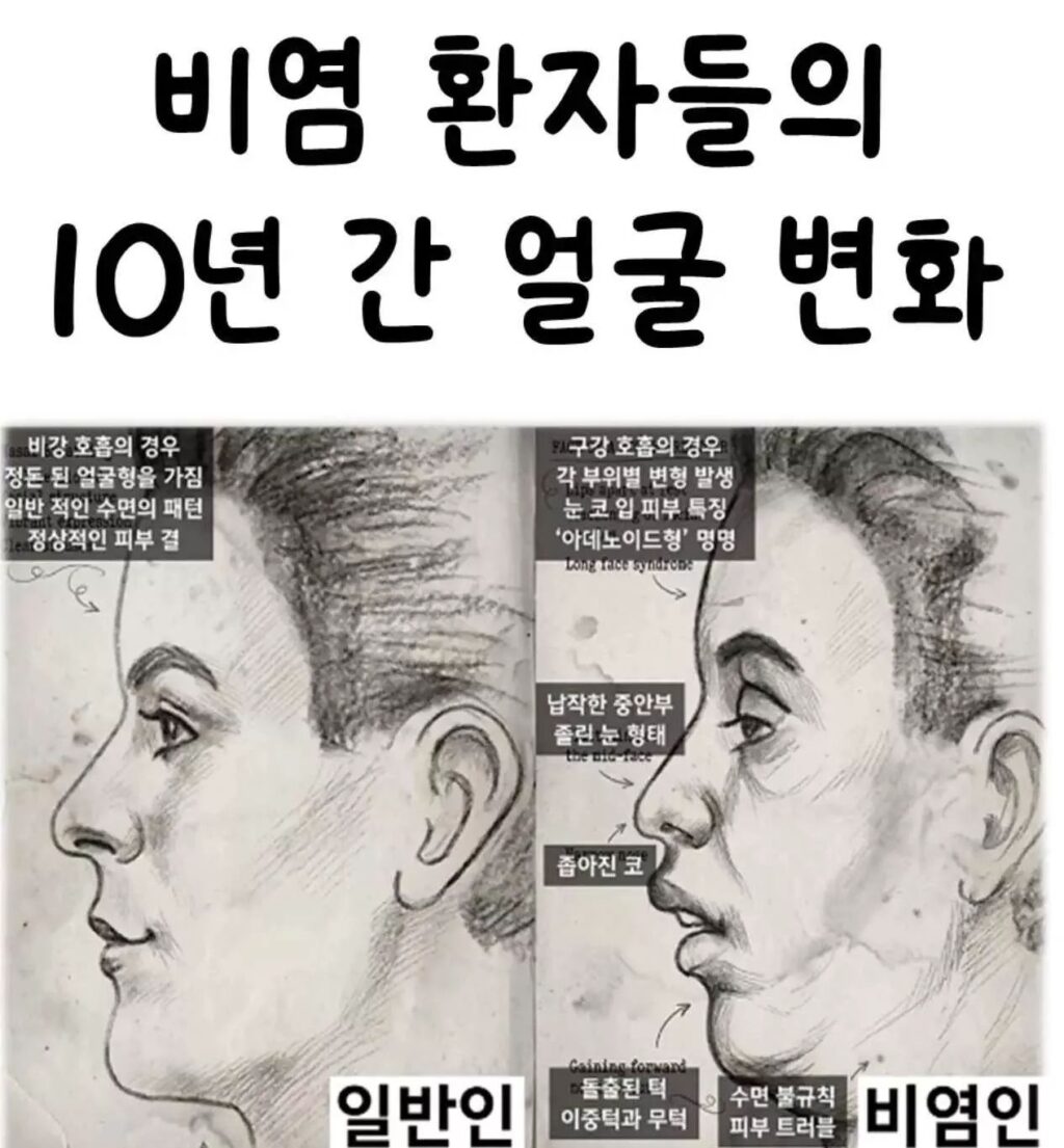 비염 환자들의 10년 간 얼굴 변화