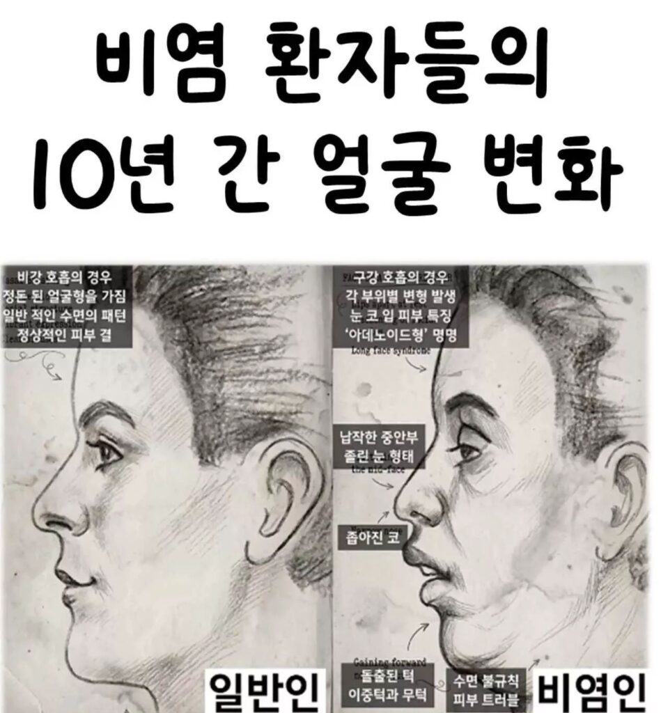 비염 환자들의 10년 간 얼굴 변화