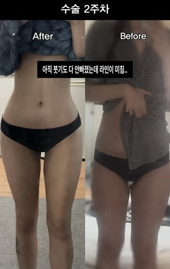 요즘 여성들에게 인기 있는 몸매 교정 시술
