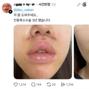 (약혐) 쓰레드에서 핫한 인중축소 성형수술 피해자들