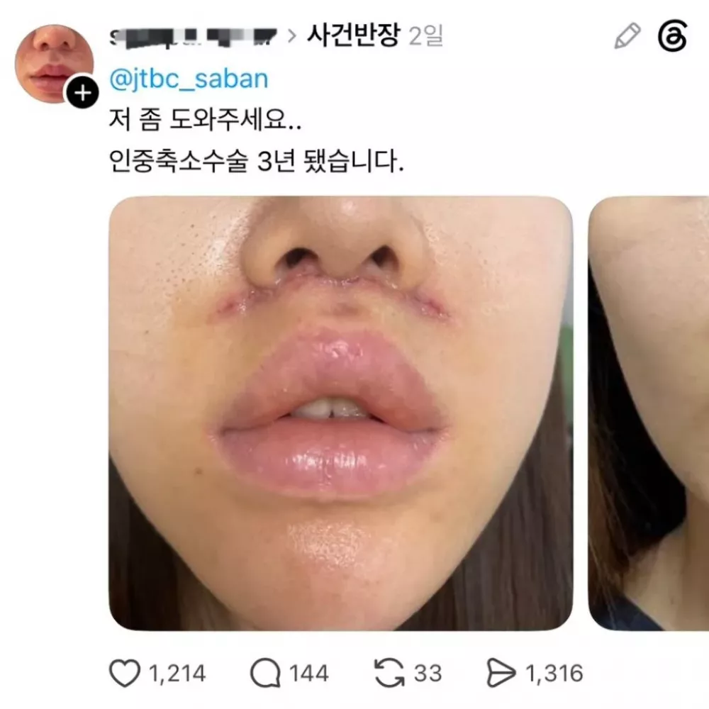 (약혐) 쓰레드에서 핫한 인중축소 성형수술 피해자들