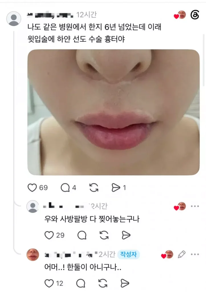 (약혐) 쓰레드에서 핫한 인중축소 성형수술 피해자들