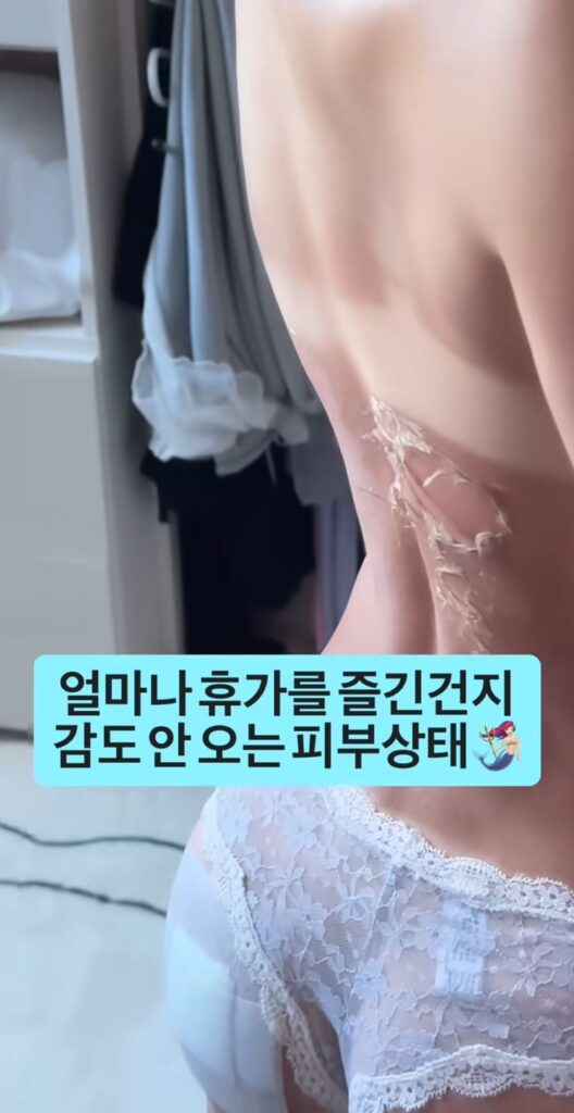 휴가 후 여자의 피부 상태 변화