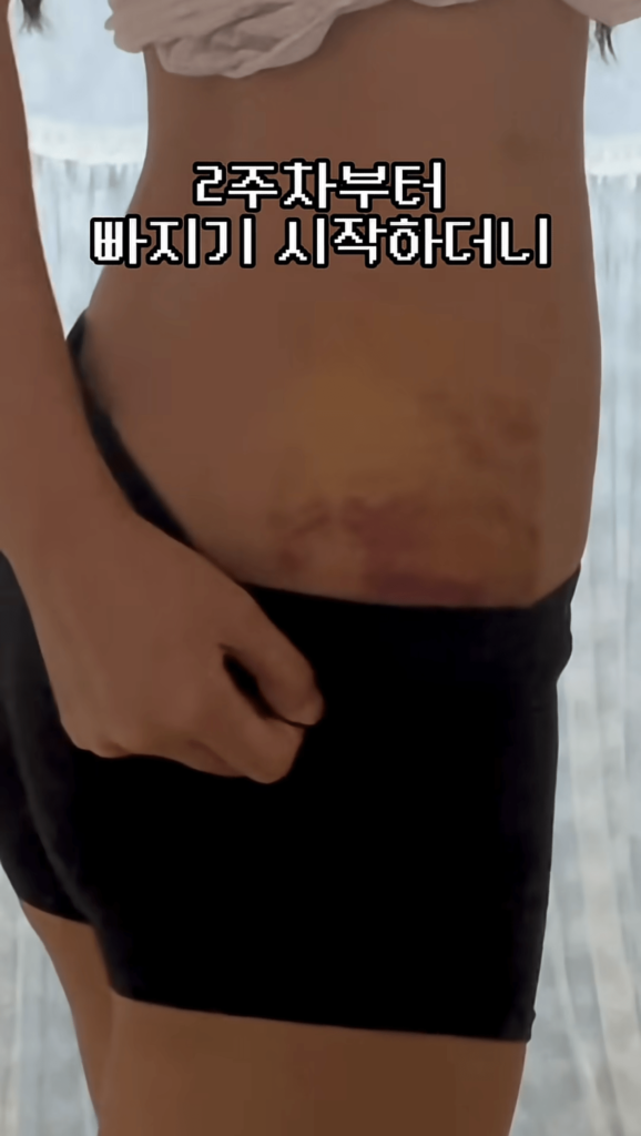 요즘 여성들에게 인기 있는 몸매 교정 시술