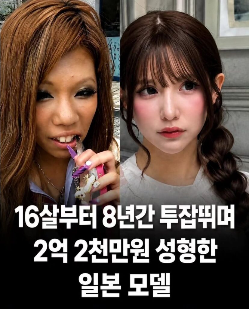 일본 모델, 2억 이상 투입 성형 수술