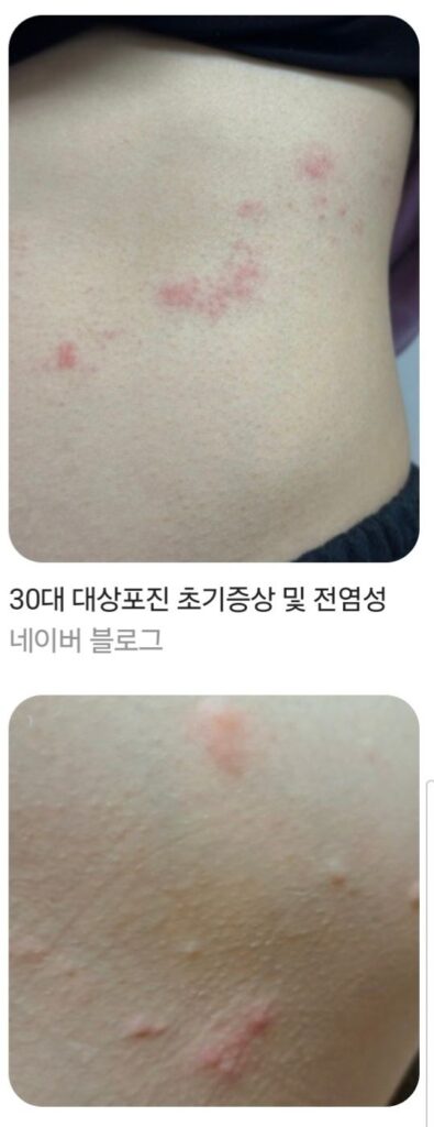 대상포진 전조 증상 알아보기