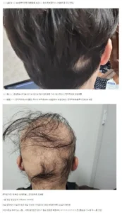 탈모갤 레전드, 디시.jpg