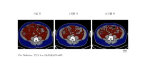 마운자로 복용 후 체지방 변화 추적 결과