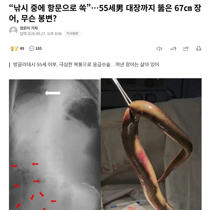 “낚시 중에 항문으로 쏙”…55세男 대장까지 뚫은 67㎝ 장어, 무슨 봉변?