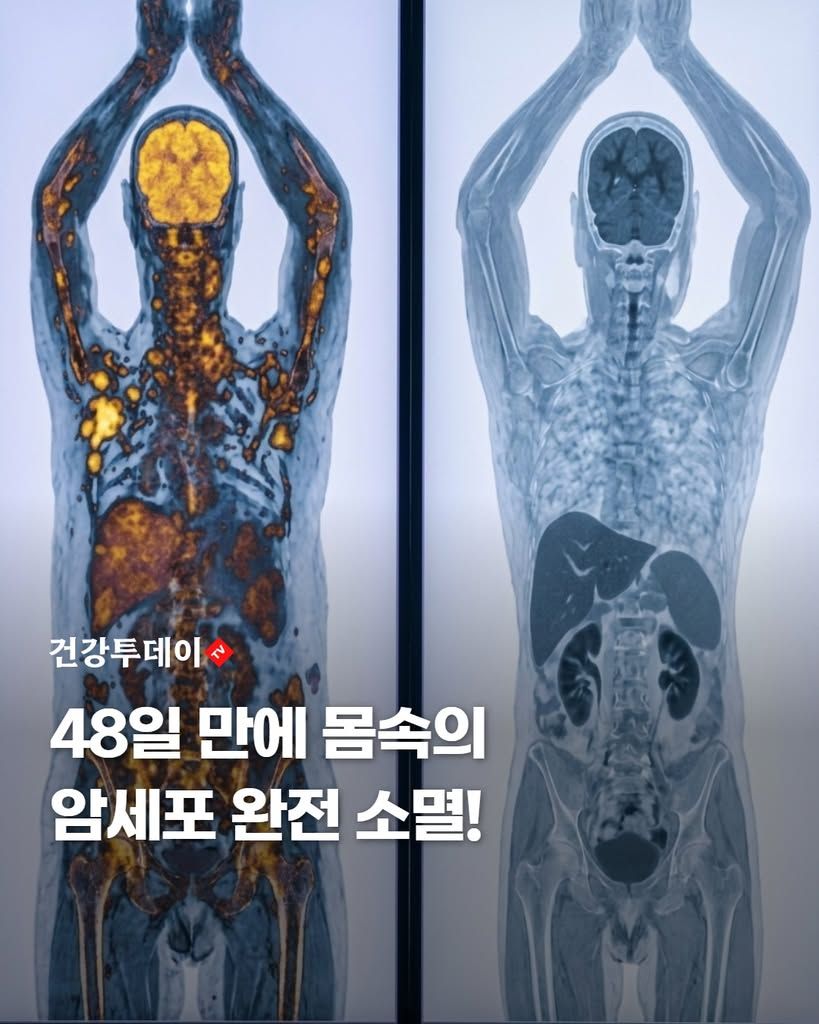 48일 만에 암세포 완전 소멸